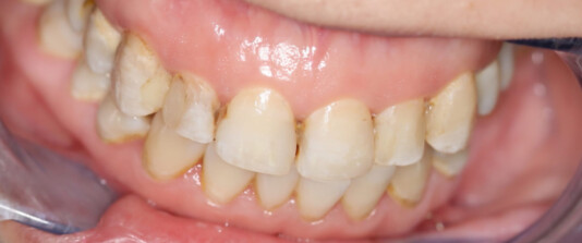 Carillas de composite