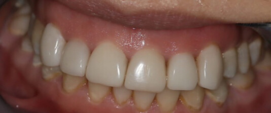 Carillas de composite