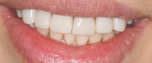 Carillas de composite