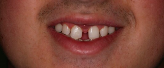 agenesias de molares