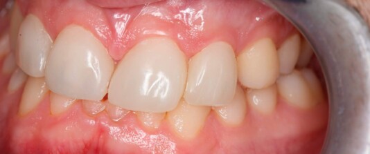 agenesias de molares