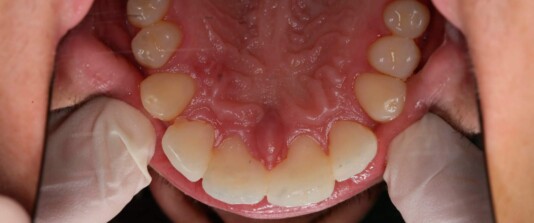 agenesias de molares