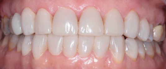 Carillas de composite