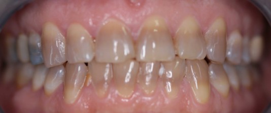 Carillas de composite