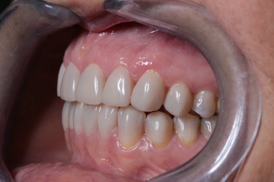 Carillas de composite