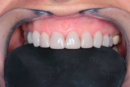 Carillas de composite