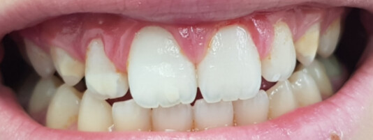 Carillas de composite