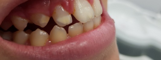 Carillas de composite