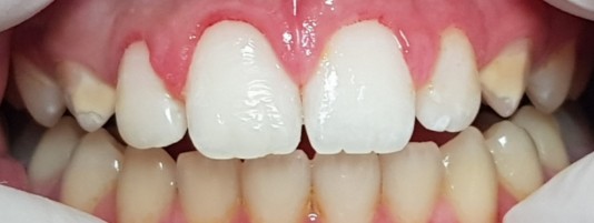 Carillas de composite