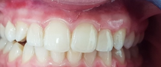 Carillas de composite