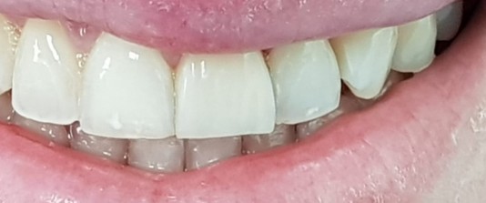 Carillas de composite