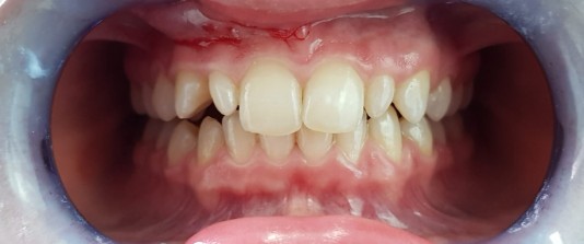 Carillas de composite