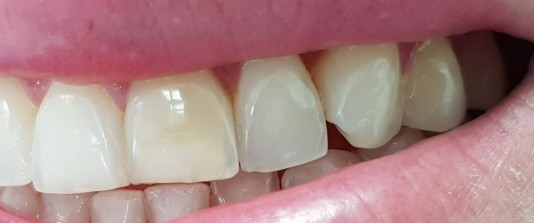 Carillas de composite