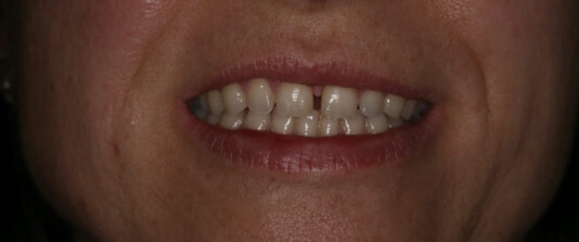 Carillas de composite