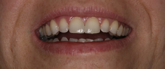 Carillas de composite