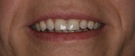 Carillas de composite