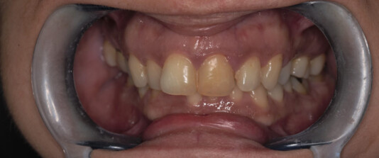 agenesias de molares