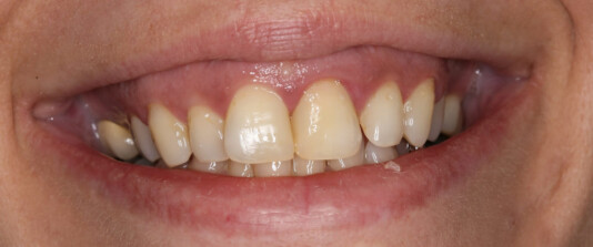 agenesias de molares