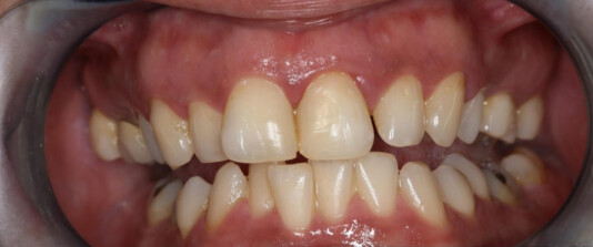 agenesias de molares